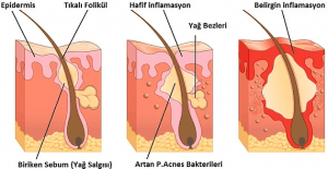 Lazer epilasyon uygulanması 1