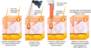 Lazer epilasyon uygulanması 3